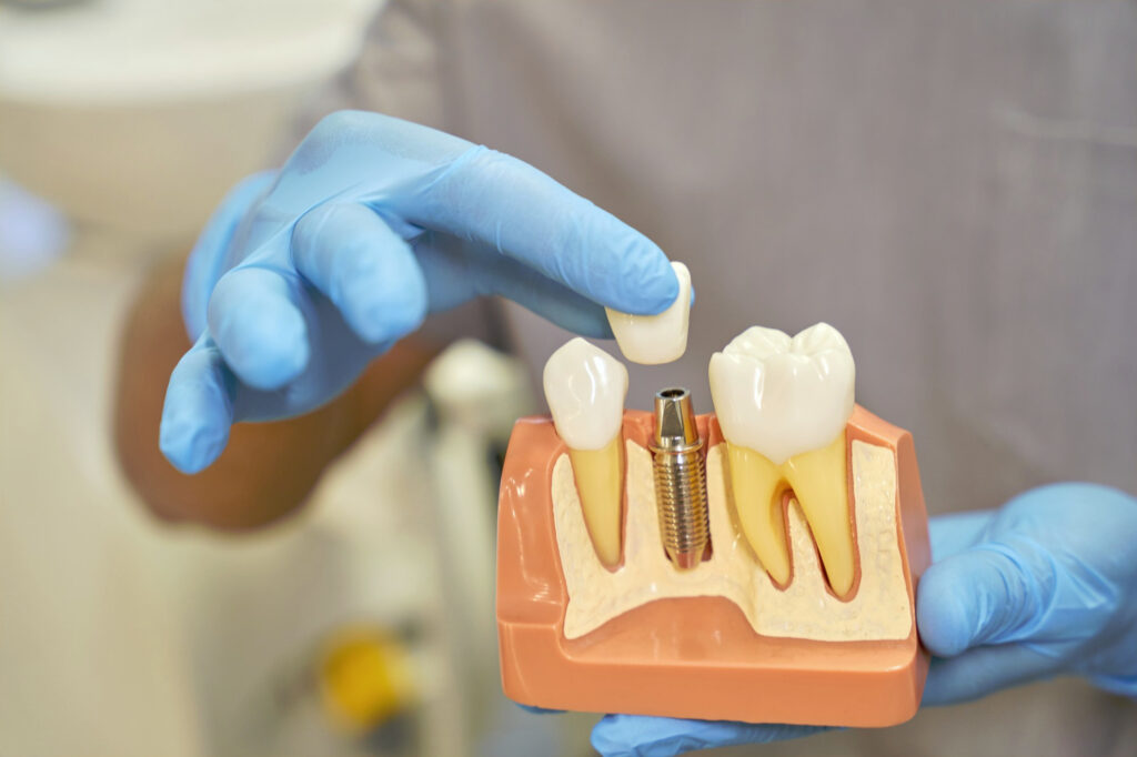 implantes dentales dentista teruel